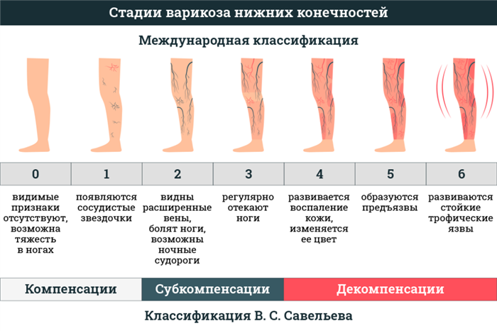 Что такое варикозное расширение вен